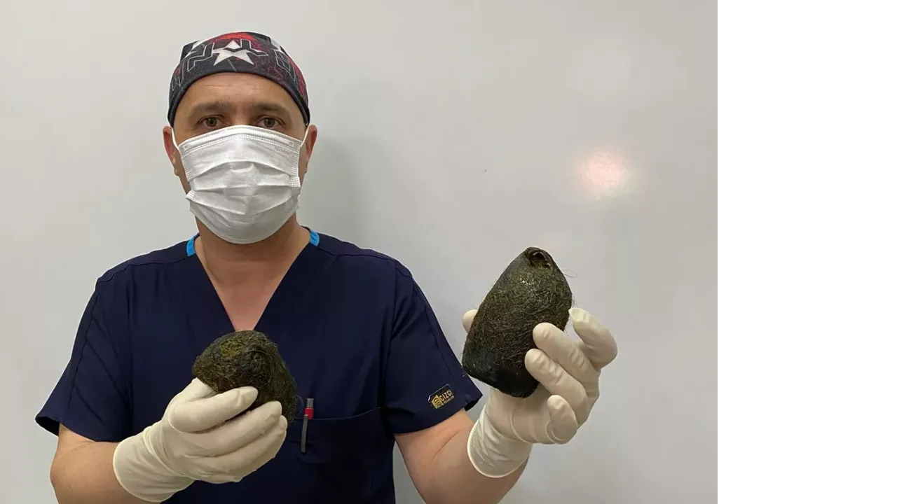 Osmaniye’de Şok Eden Olay: Midesinden 2 kilo saç çıktı