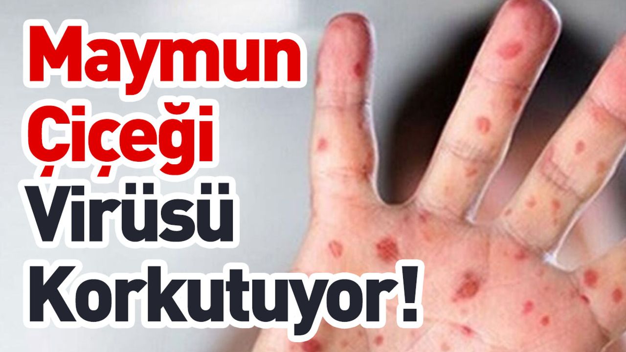 Maymun Çiçeği Virüsü Korkutuyor! İşte Almanız Gereken Önlemler!