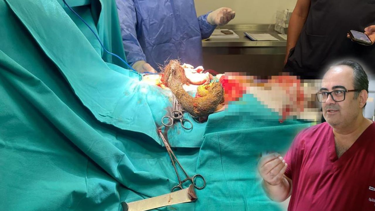 Kayseri'de Şaşırtan Olay! Midesinden 3.5 Kilo Saç Kılı Çıktı