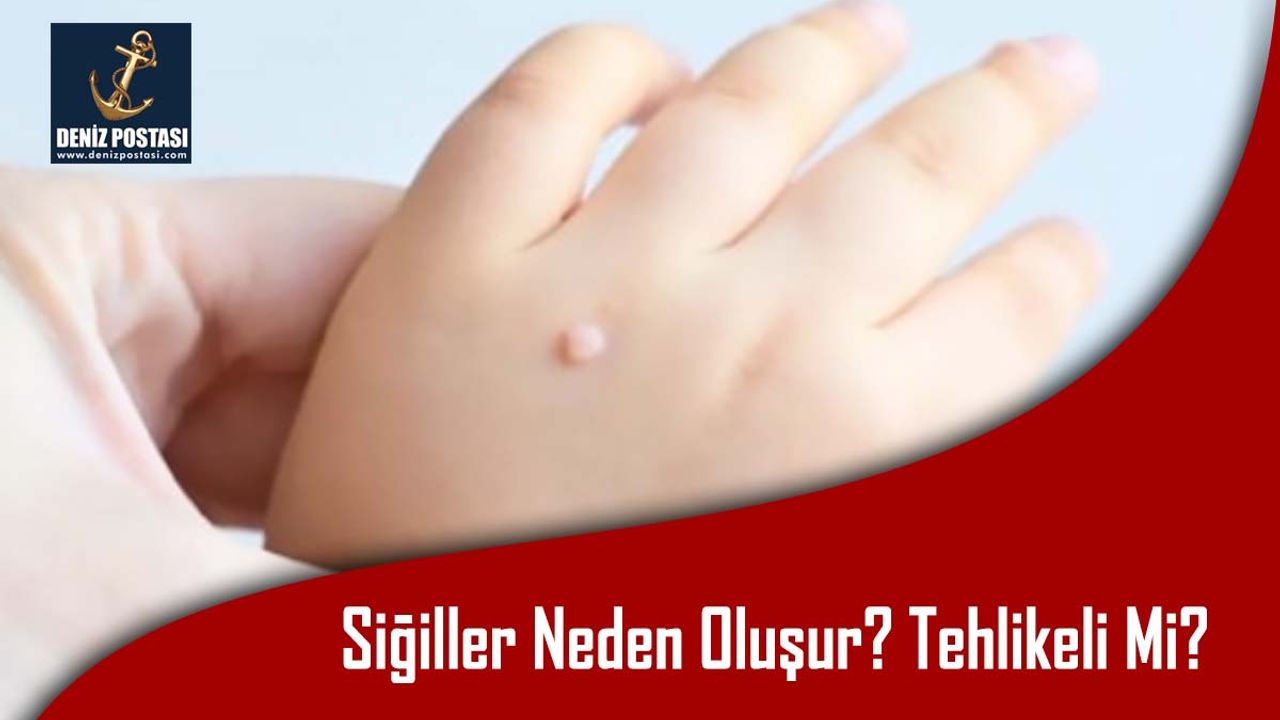 Siğiller Neden Oluşur? Tehlikeli Mi?