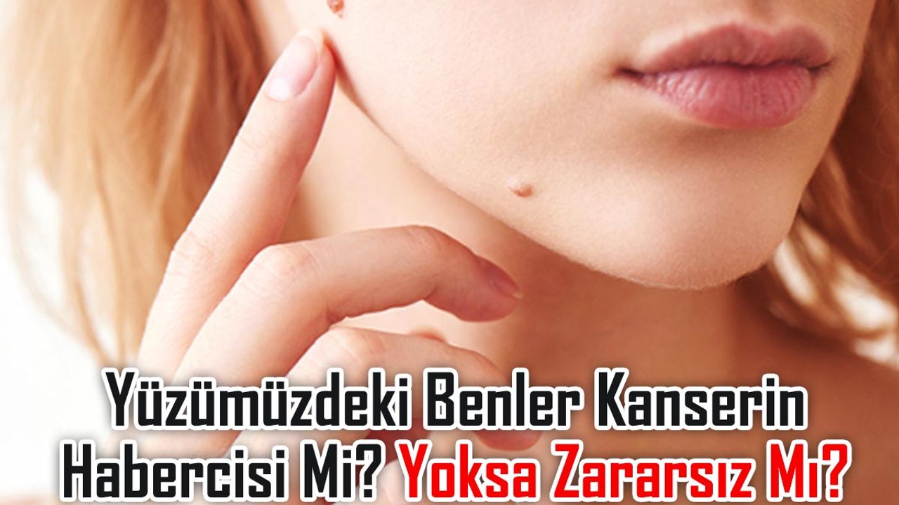 Yüzümüzdeki Benler Kanserin Habercisi Mi? Yoksa Zararsız Mı?