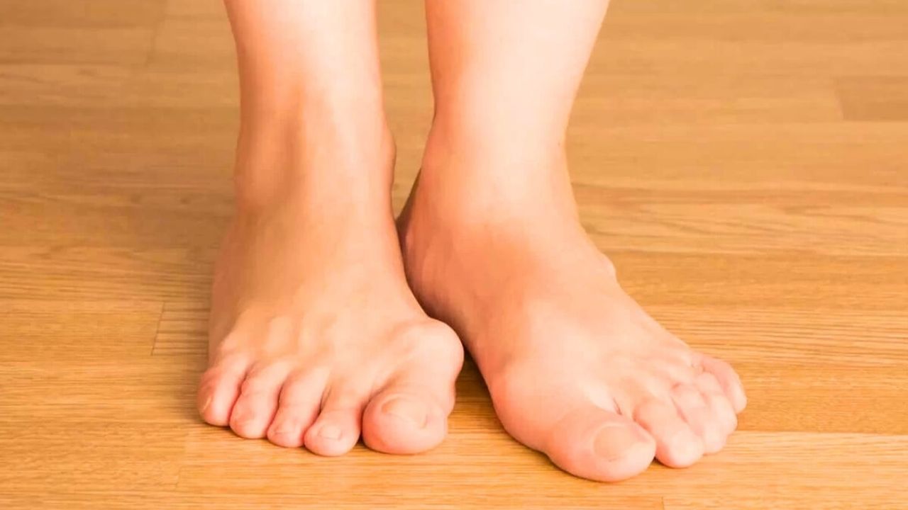 Ayak Şeklinizdeki Bozukluklar Ciddi Olabilir! İhmal Etmeyin