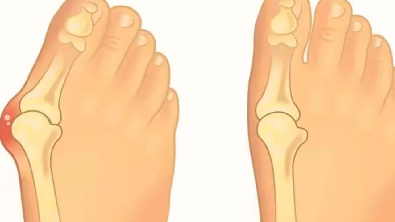 Bunion Nedir ve Tedavisi Var mı? Ayak Sağlığınız İçin Önemli Bilgiler