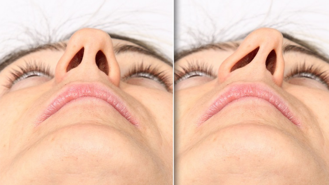 Septoplasti ile Burun Eğriliğine Son!