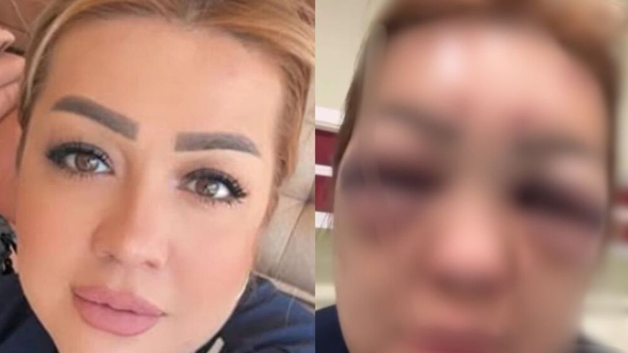 Kuaför kadın botoks yaptırdı! Yüzü tanınmayacak hale geldi!