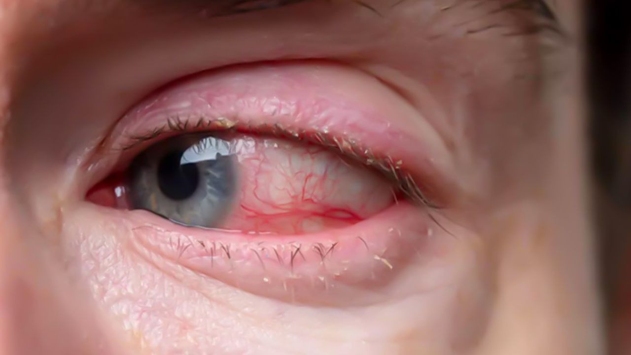 Retina dekolmanı nedir? Ani ışık çakmalarına dikkat!