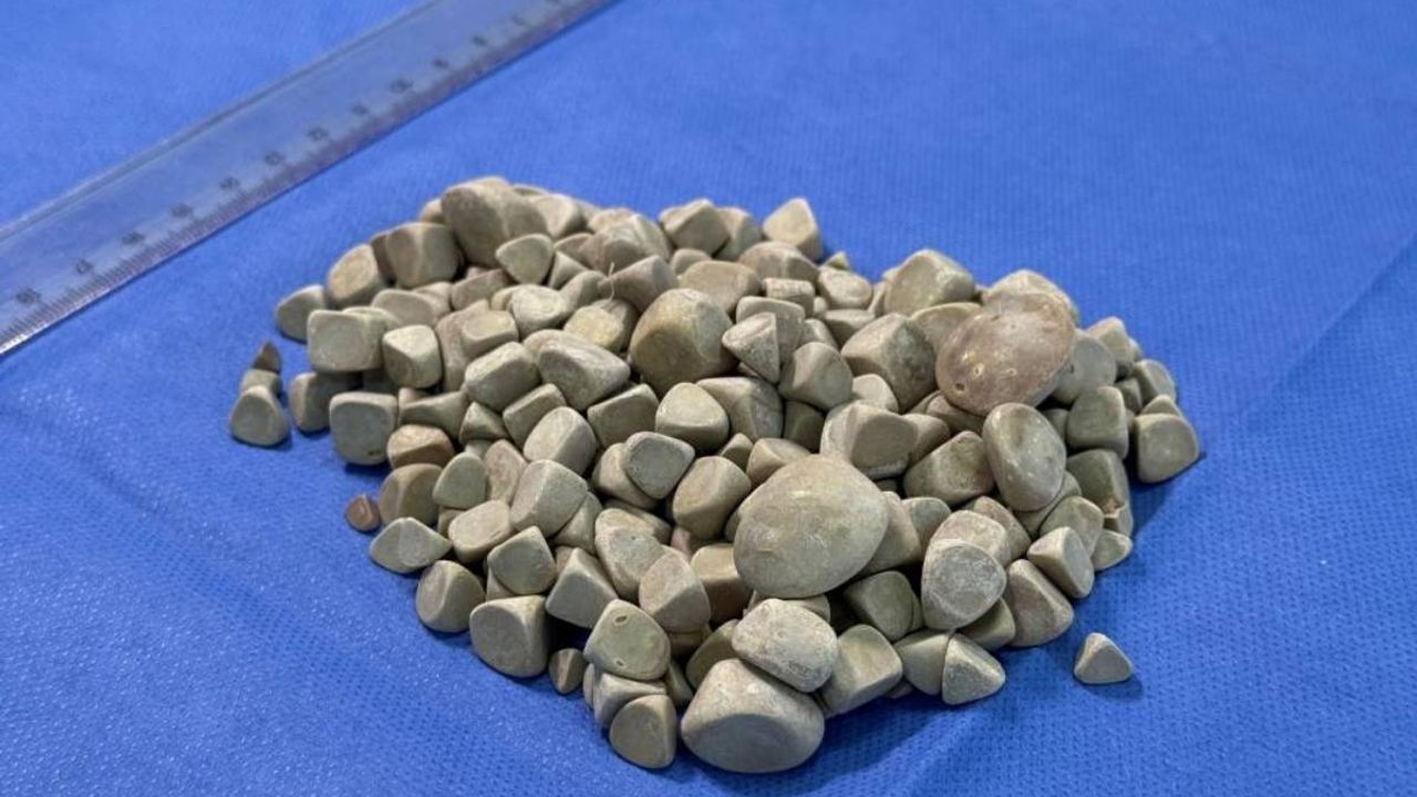 21 Yaşında ki gencin vücudundan 287 taş çıkarıldı