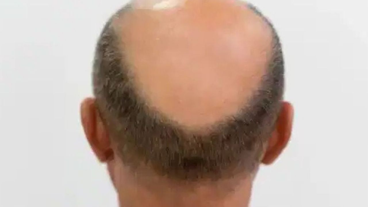 Kellik tarihe karışıyor: 3 haftada saç çıkaran 'mucize serum' geliştirildi!