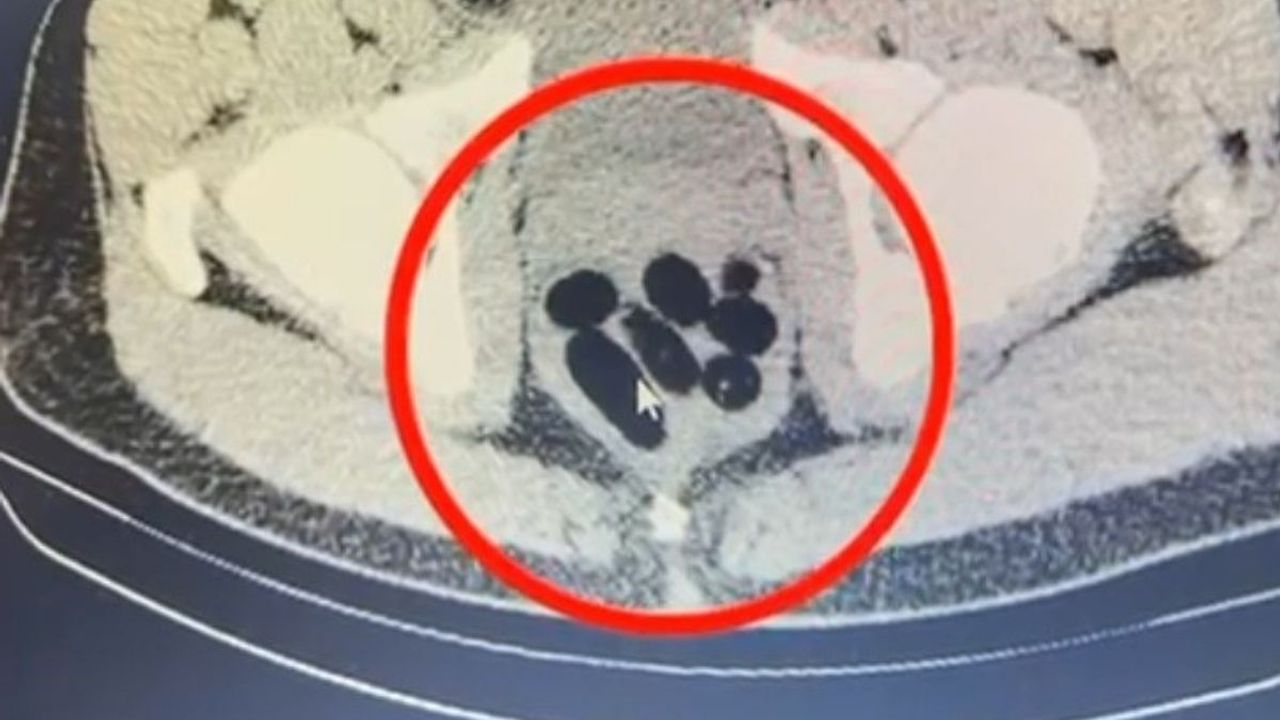 Kayseri’de uyuşturucu kuryesi kadının midesinden 500 gram metamfetamin çıktı