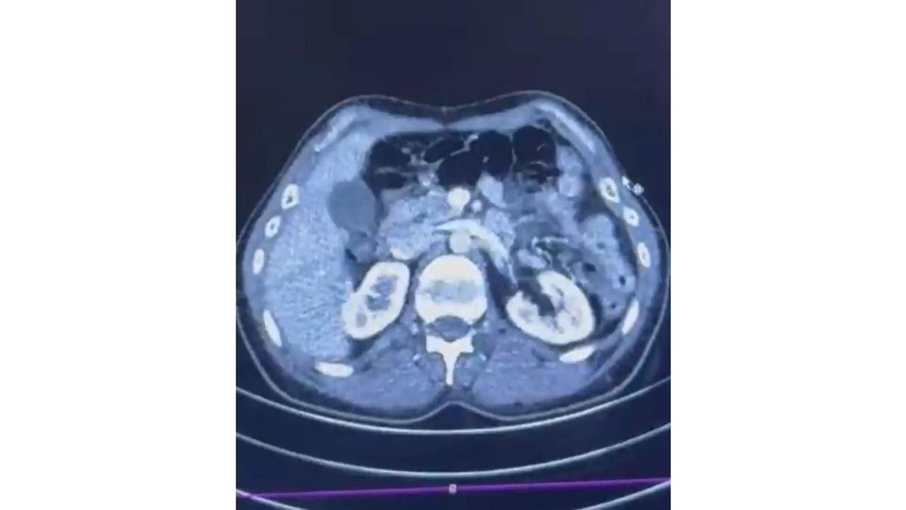 Kayseri'de uluslararası uyuşturucu ticareti: Midesinden 50 kapsül metamfetamin çıktı
