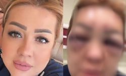 Kuaför kadın botoks yaptırdı! Yüzü tanınmayacak hale geldi!