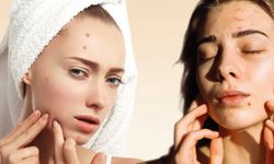 Yetişkinlikte Hormonal Akne Nedenleri ve Çözüm Yolları