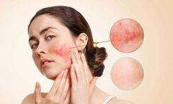 Rosacea (Gül Hastalığı) nedir? Tetikleyen 10 faktör