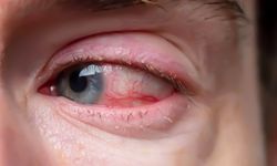 Retina dekolmanı nedir? Ani ışık çakmalarına dikkat!
