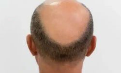 Kellik tarihe karışıyor: 3 haftada saç çıkaran 'mucize serum' geliştirildi!