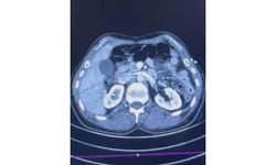 Kayseri'de uluslararası uyuşturucu ticareti: Midesinden 50 kapsül metamfetamin çıktı
