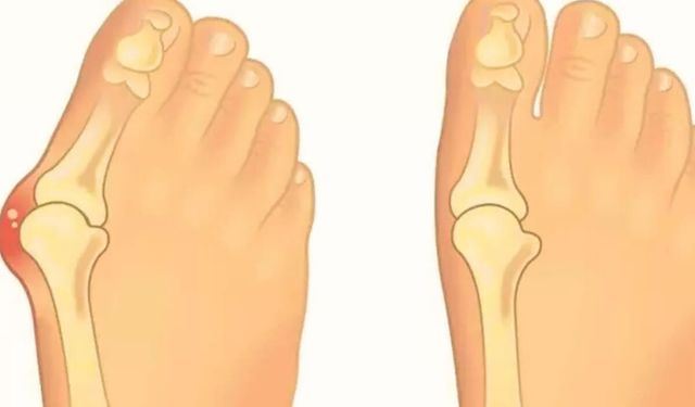 Bunion Nedir ve Tedavisi Var mı? Ayak Sağlığınız İçin Önemli Bilgiler