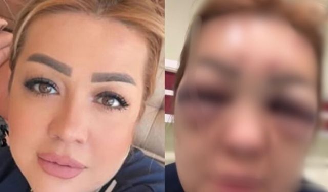 Kuaför kadın botoks yaptırdı! Yüzü tanınmayacak hale geldi!