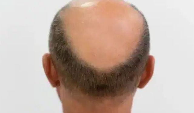 Kellik tarihe karışıyor: 3 haftada saç çıkaran 'mucize serum' geliştirildi!