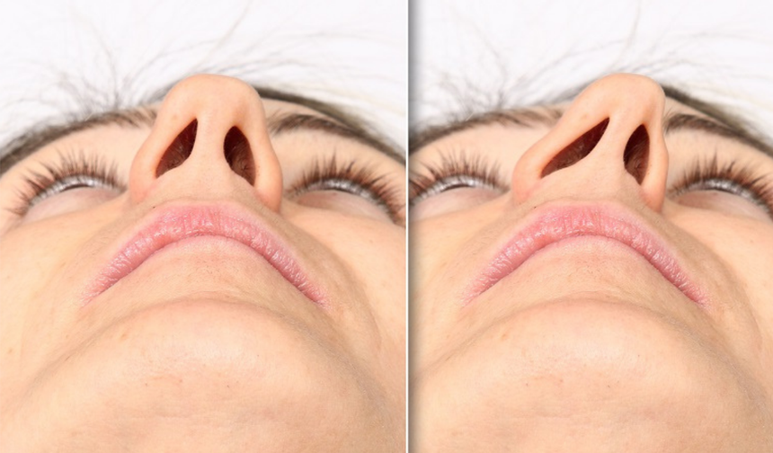 Septoplasti ile Burun Eğriliğine Son!