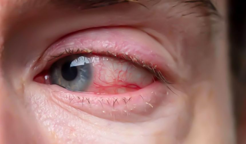 Retina dekolmanı nedir? Ani ışık çakmalarına dikkat!