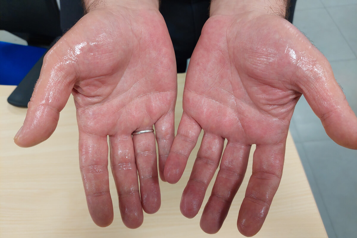 avuç içi terlemesi, palmar hiperhidroz