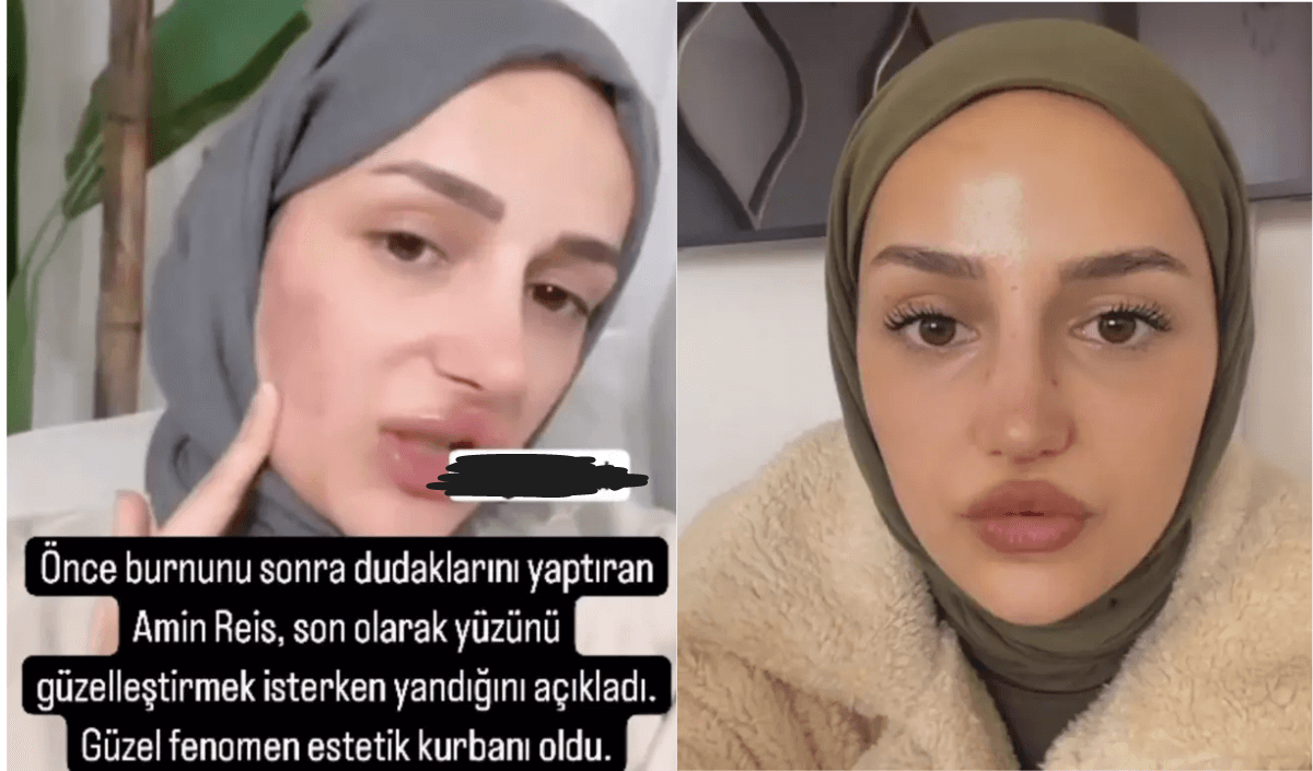 Bu kez âmin diyemedi! Estetik kurbanı olan ünlü fenomenin yüzü yandı!