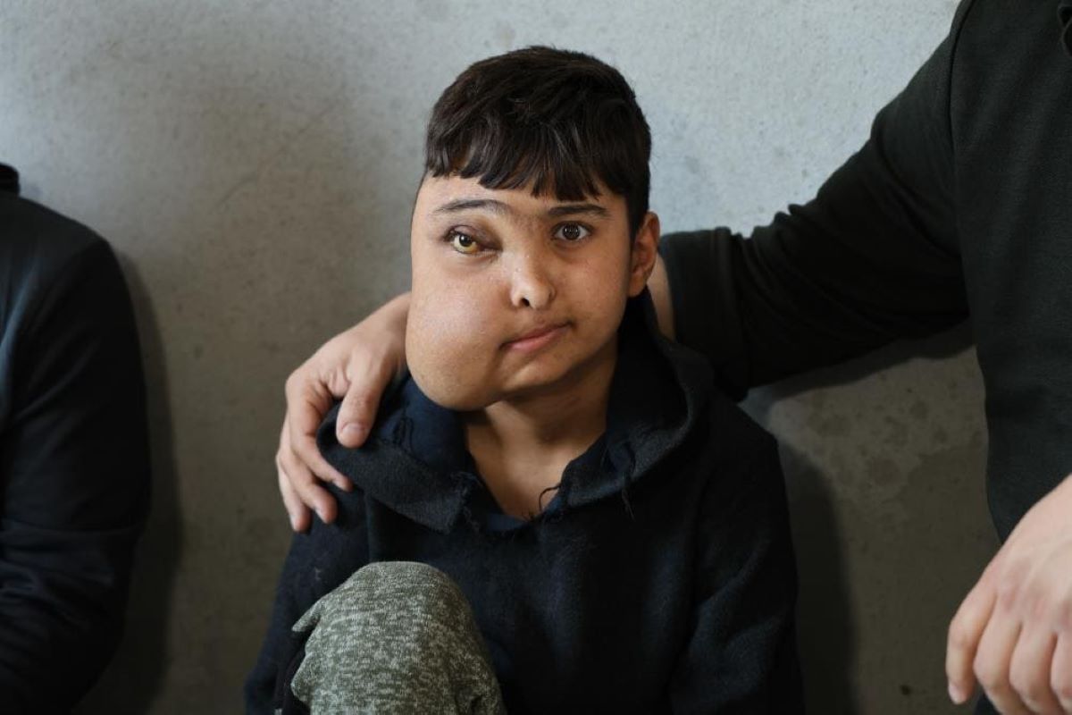 İki Farklı Yüzü Varmış Gibi Gözüken Enes, Gen Tedavisi Ile Sağlığına Kavuşacak! 2