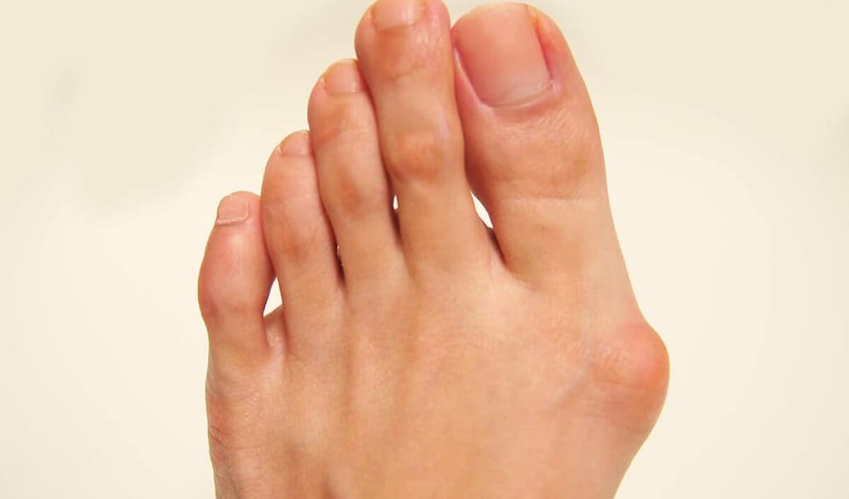 Bunion Nedir Ve Tedavisi Var Mı Ayak Sağlığınız İçin Önemli Bilgiler (3)