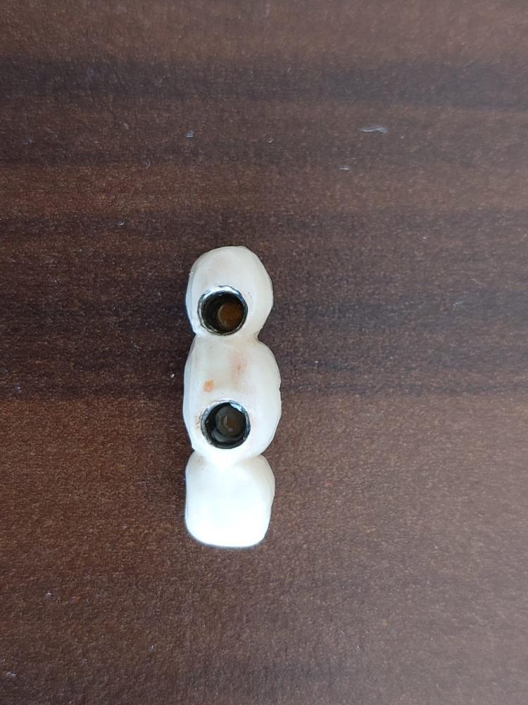 kayseri'de özel hastanede implant