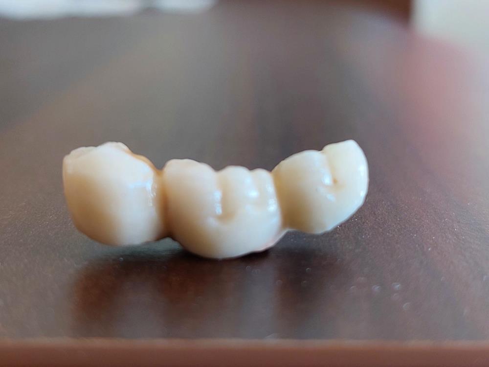 kayseri'de özel hastanede implant